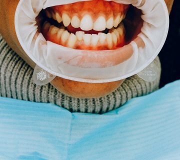 Verschillende wijzen om tandvleesproblemen tegen te gaan